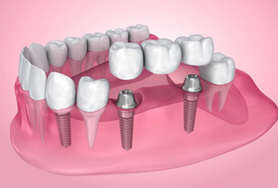 Exploded illustration of dental implants with bridge.